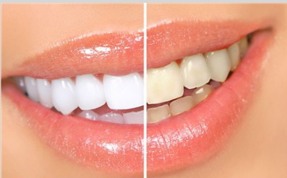 Ինչպե՞ս սպիտակեցնել ատամները տնային պայմաններում