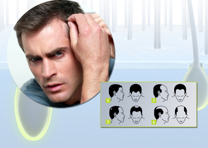 Ի՞նչ անել, երբ տղամարդու մազերն սկսում են արագորեն թափվել